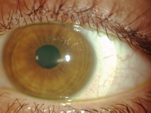 Scleral contact lens